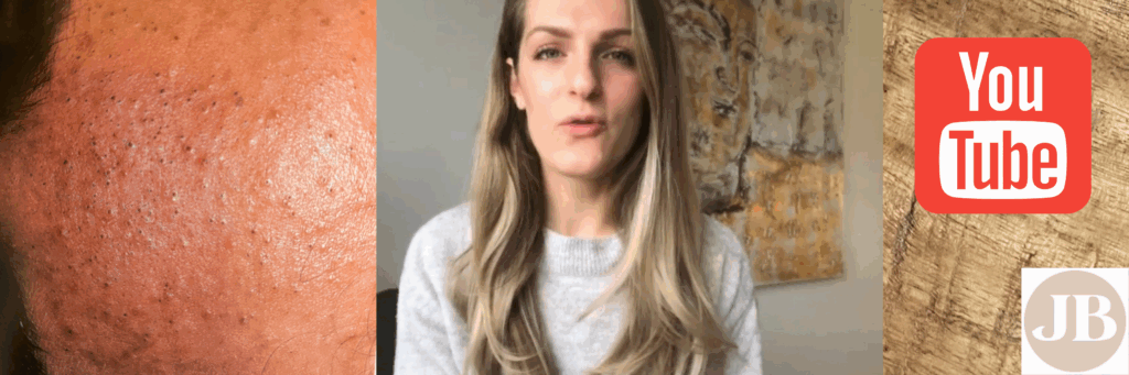 Alles over comedonen