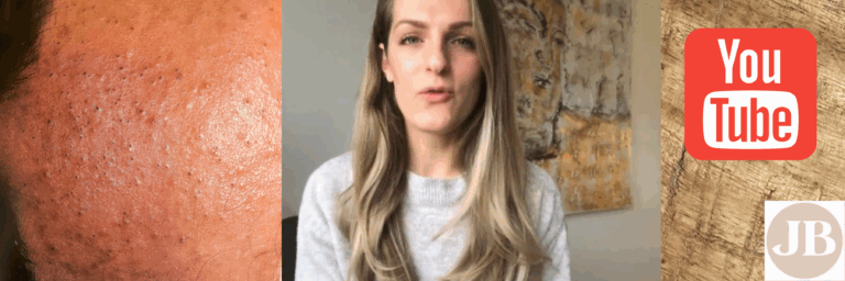 Alles over comedonen