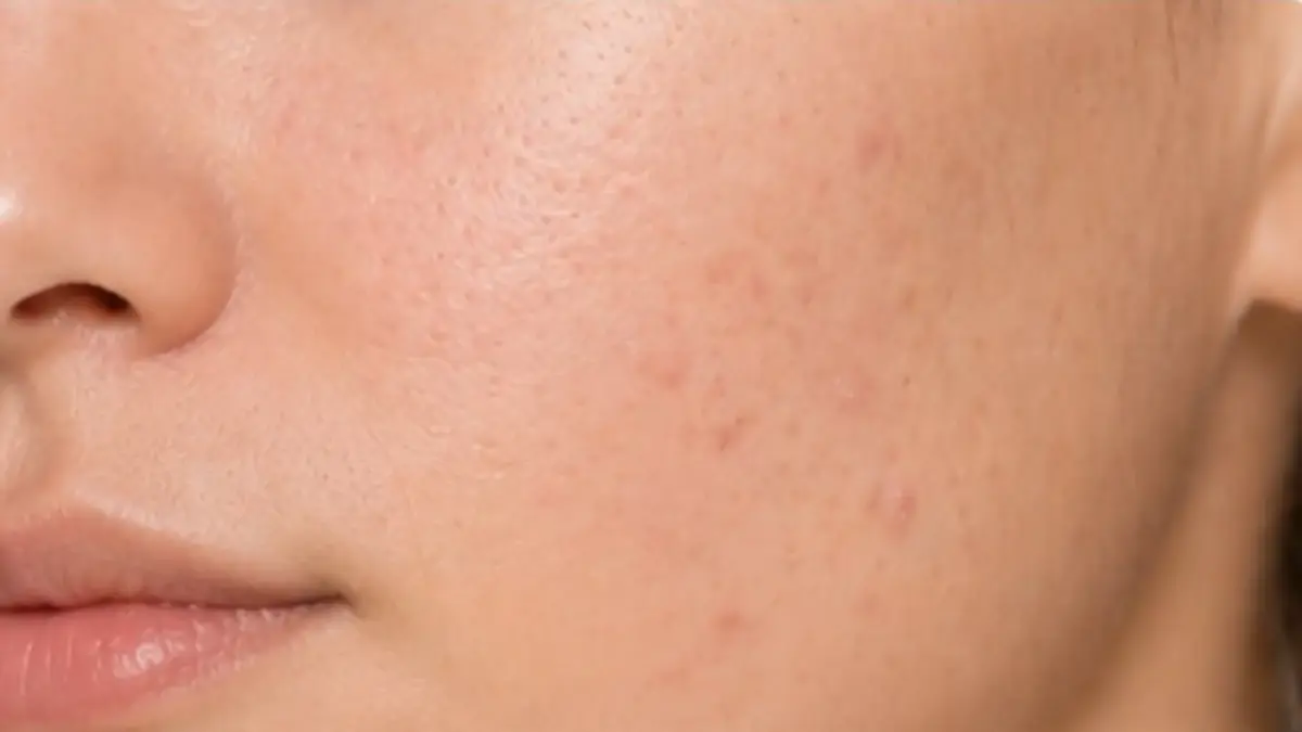Acne-gevoelige huid