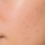 Acne-gevoelige huid
